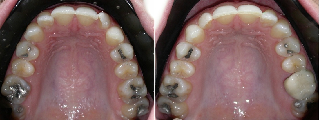 Dr. Avo Fronjian Invisalign Before and After AM8