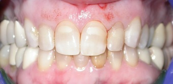 Avo Fronjian Before and After 15