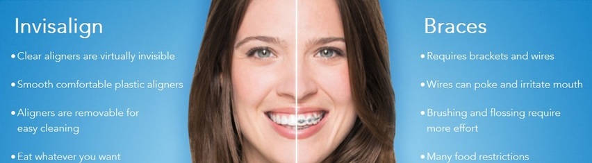 Avo Fronjian Invisalign 1