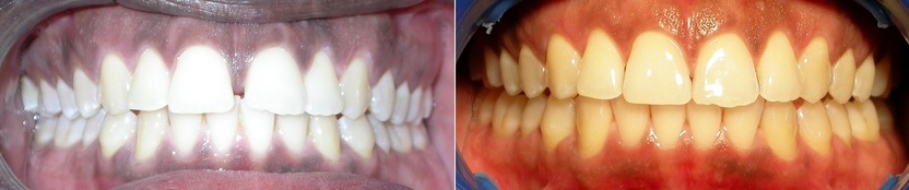 Dr. Avo Fronjian Invisalign Before and After KC9
