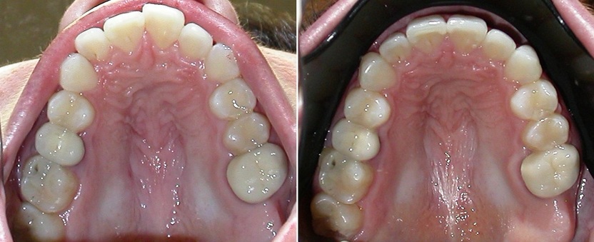 Dr. Avo Fronjian Invisalign Before and After KY8