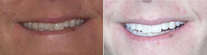 Dr. Avo Fronjian Invisalign Before and After KG3