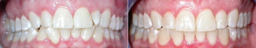 Dr. Avo Fronjian Invisalign Before and After KH7