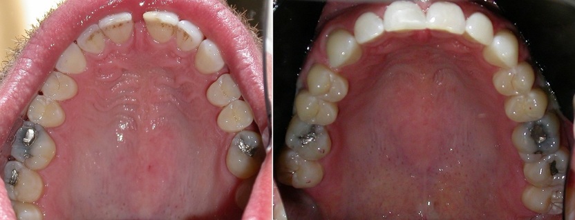 Dr. Avo Fronjian Invisalign Before and After BD5