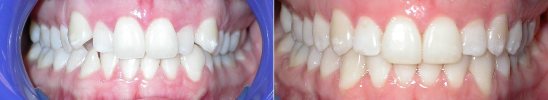 Dr. Avo Fronjian Invisalign Before and After TM9