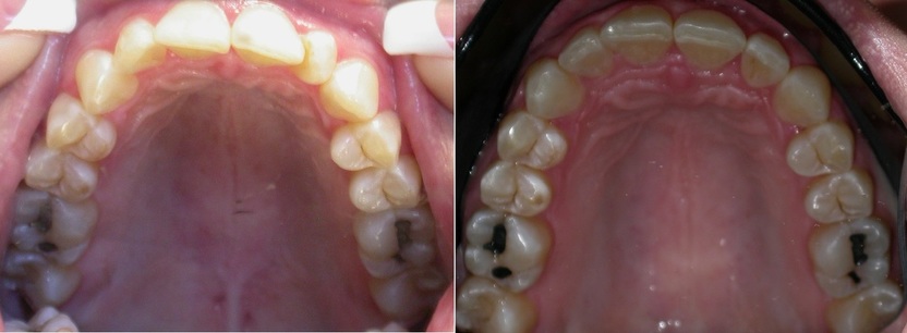 Dr. Avo Fronjian Invisalign Before and After KH9