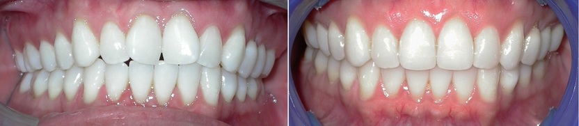 Dr. Avo Fronjian Invisalign Before and After SE6