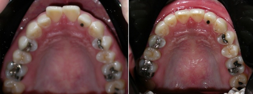 Dr. Avo Fronjian Invisalign Before and After CA5