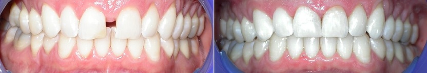 Dr. Avo Fronjian Invisalign Before and After BD6