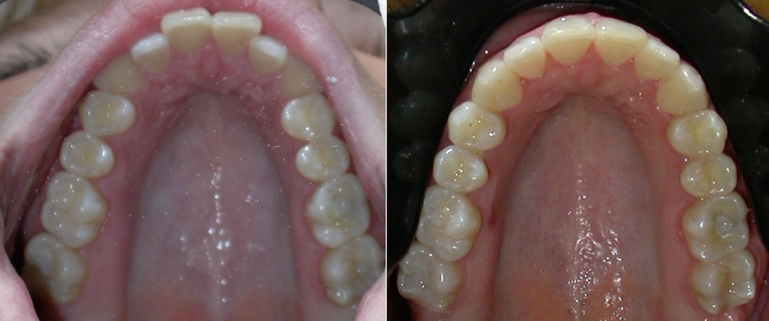 Dr. Avo Fronjian Invisalign Before and After TM7