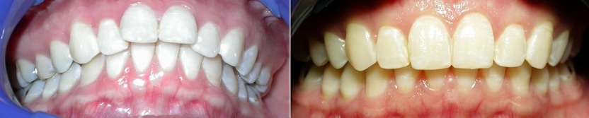 Dr. Avo Fronjian Invisalign Before and After CA6