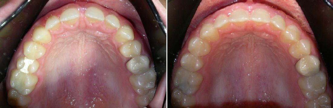 Dr. Avo Fronjian Invisalign Before and After TA3