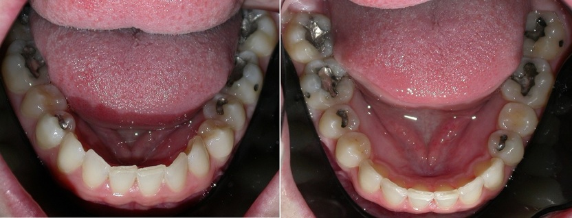 Dr. Avo Fronjian Invisalign Before and After AM7