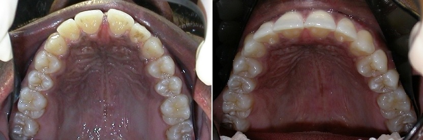 Dr. Avo Fronjian Invisalign Before and After KC8